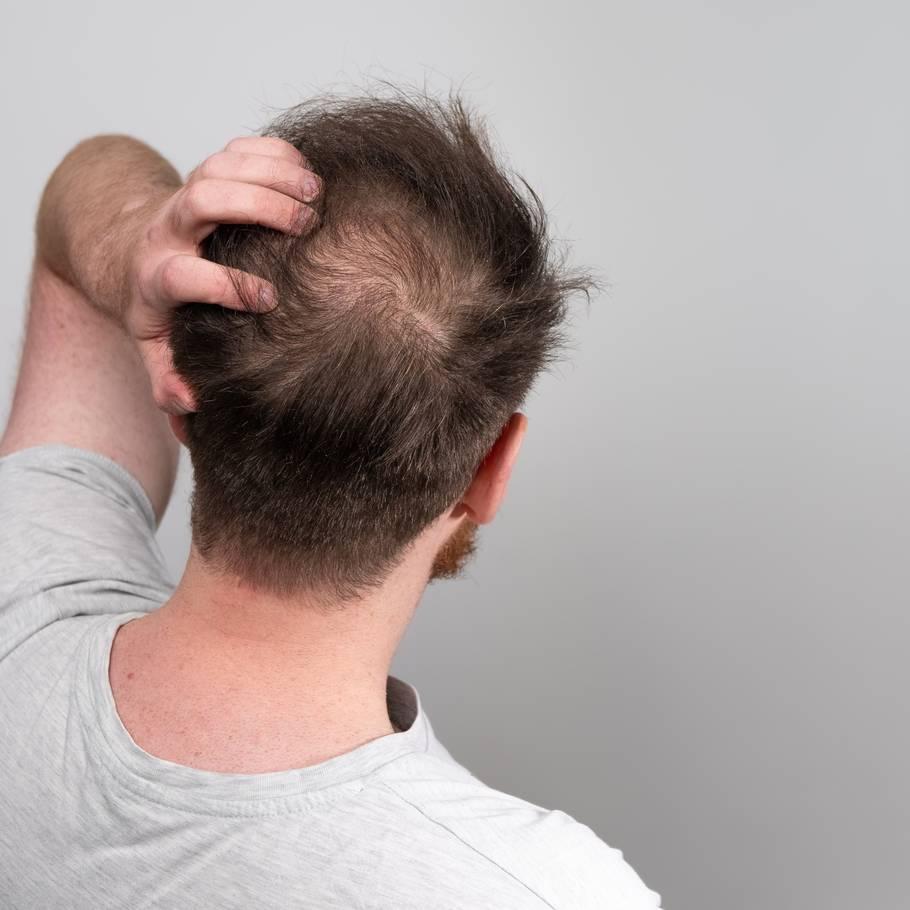latest research male pattern baldness