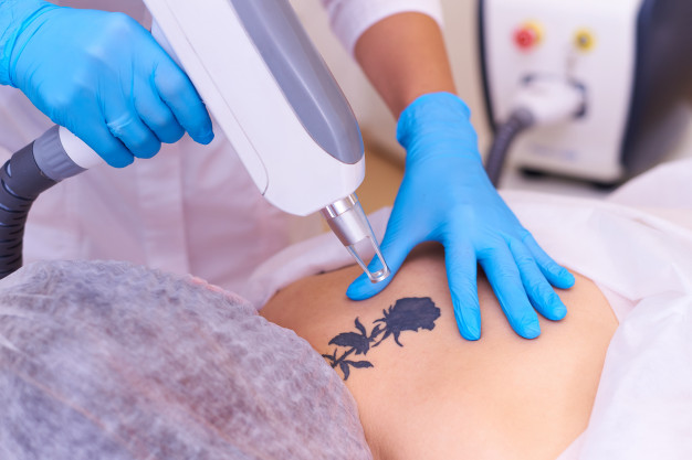 Laser Tattoo Removal Procedure at SIAN Skincare Clinic