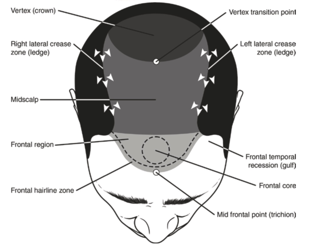 FMS HAIR - Best Hair transplant clinic in Hyderabad India