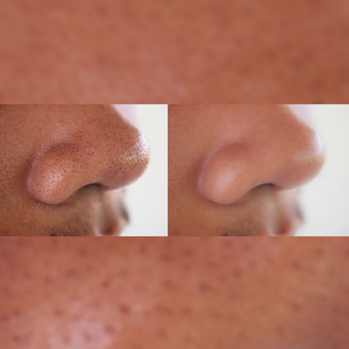 Blackheads Removal Treatment in Hyderabad