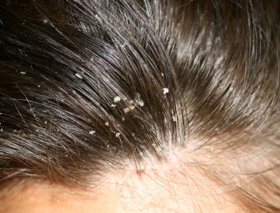 FMS SKIN & HAIR: Best Dandruff Treatment in Hyderabad, India